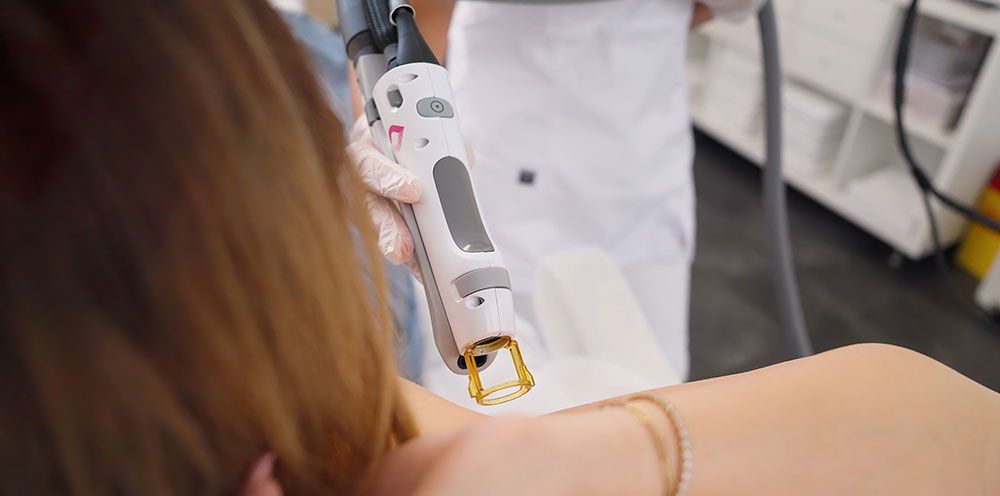 Moderne Laserbehandlung für effektive Haarentfernung im Lissera Laserzentrum Stuttgart